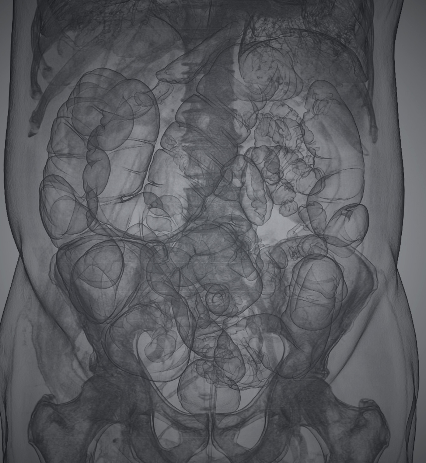 가상 대장내시경을 위한 3D CT 스캔 영상으로, 대장과 주변 복부 구조를 상세히 보여줌